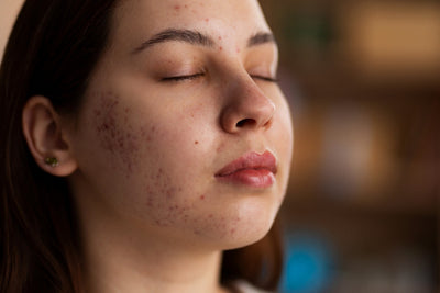 Before-and-after skin transformation showing reduced pigmentation and brighter skin tone