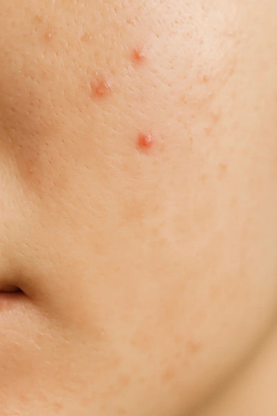 Close-up of dark spots and pigmentation on cheek before skincare treatment